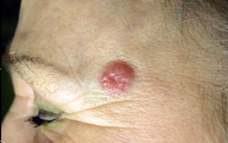 Carcinoma basocelular
