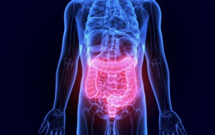 Colostomia
