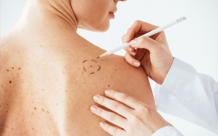 Melanoma